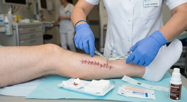 cotation-ablation-fils cotation-ablation-fils